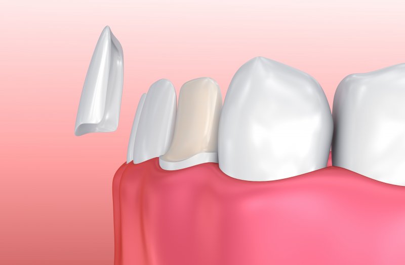 dental implants hawthorne ca